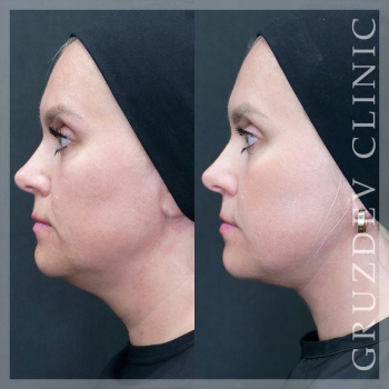 Тройная подтяжка лица (Triple Face Lift): фото до и после, результат 1