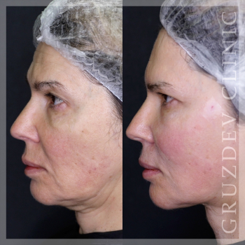 Тройная подтяжка лица (Triple Face Lift): фото до и после, результат 2