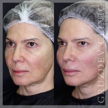 Тройная подтяжка лица (Triple Face Lift): фото до и после, результат 3